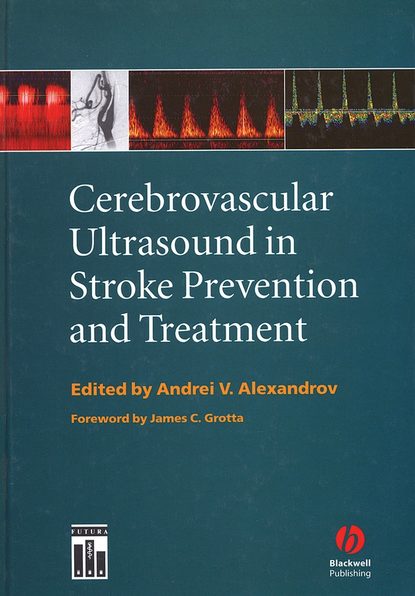 Andrei Alexandrov V. - Cerebrovascular Ultrasound in Stroke Prevention and Treatment