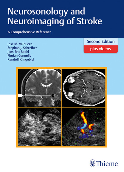 

Neurosonology and Neuroimaging of Stroke