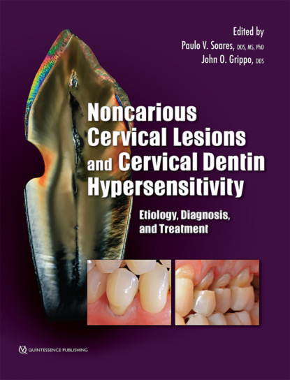 Paulo V. Soares - Noncarious Cervical Lesions and Cervical Dentin Hypersensitivity