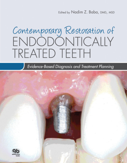 Nadim Z. Baba - Contemporary Restoration of Endodontically Treated Teeth