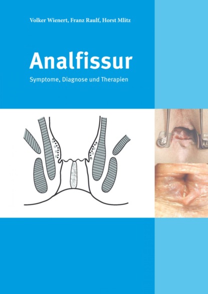 Analfissur